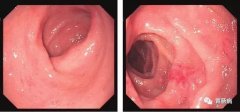 萎縮性胃炎不可怕，只要