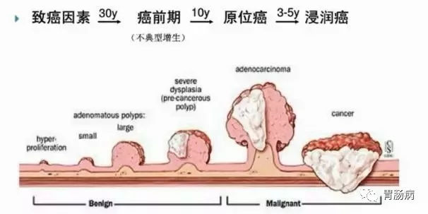 體檢查出腸息肉一定要切除！ 95%腸癌由它演變而來