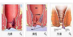 南寧治療外痔需要多少費(fèi)用