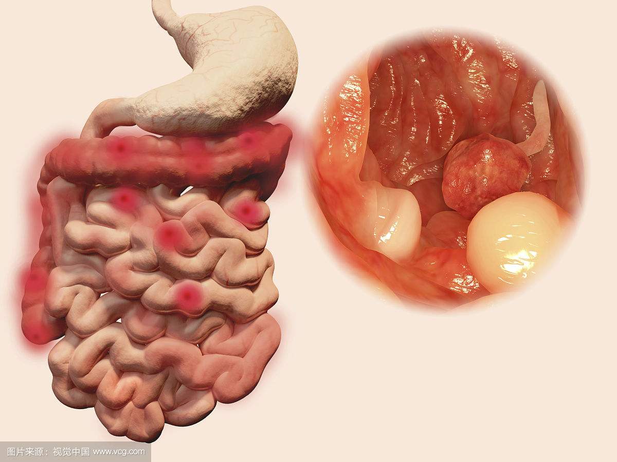 南寧治療結(jié)腸炎需要多少錢