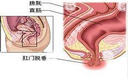 南寧治療脫肛哪家醫(yī)院好？南寧脫肛治療多少錢？